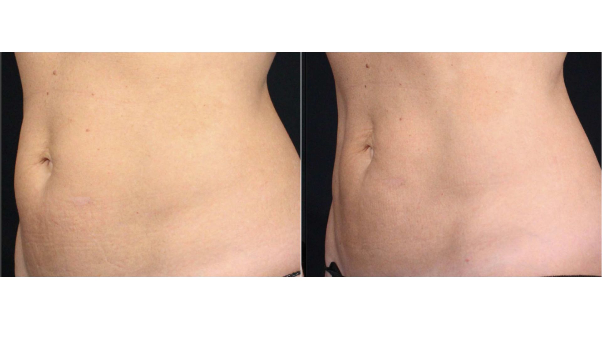 trusculpt body sculpting before and after3