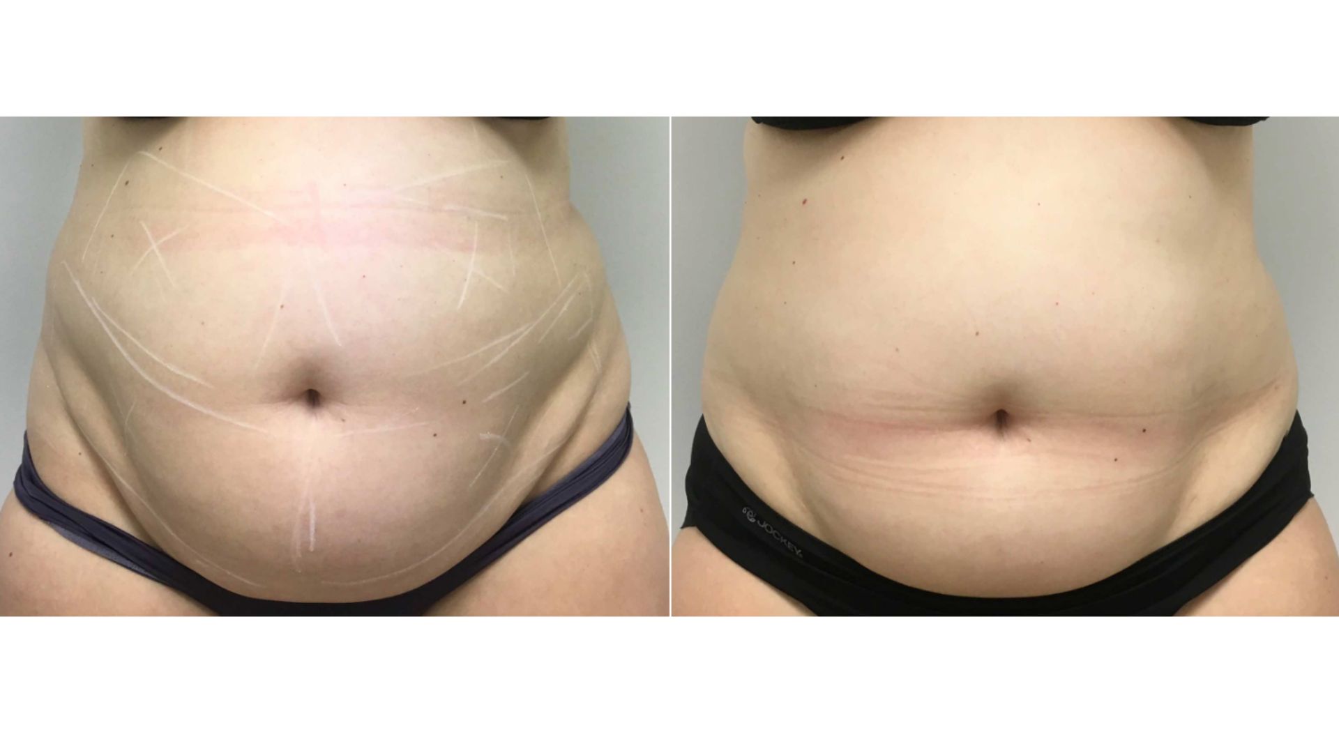 trusculpt body sculpting before and after3