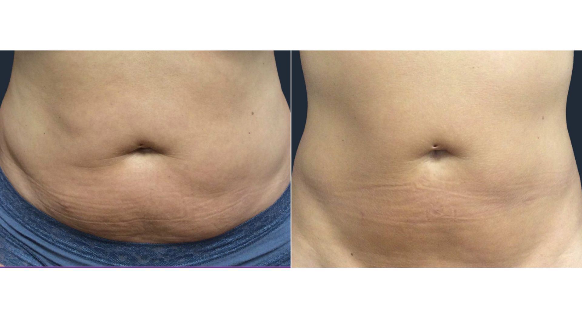 trusculpt body sculpting before and after3
